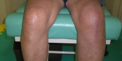 膝の障害のリハビリ